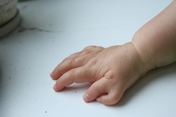 Polydactyly  Preaxial, Polydactyly on human; rare abnormal characteristic causes by chromosome,...