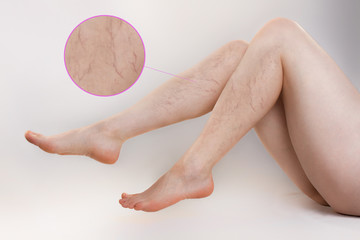 The concept of varicose disease and cosmetology. The woman sits, playfully spreading her slender legs with varicose veins. The enlarged image of blood vessels