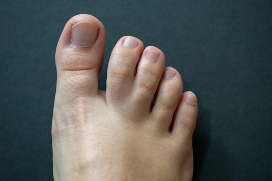 Syndactyly 85 Adobe Stock syndactyly-85-adobe-stock