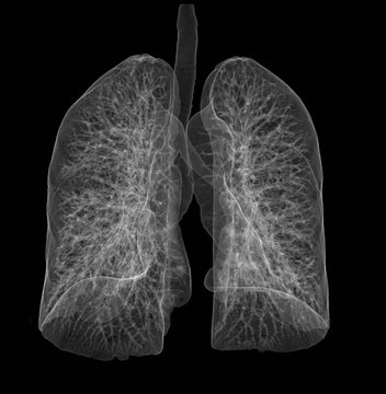 CT 3D SCAN of the lungs.