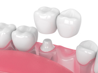 3d render of jaw with dental cantilever bridge