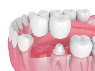 3d render of jaw with dental cantilever bridge