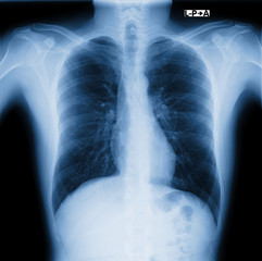 xray of chest