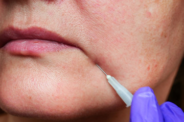 cosmetic injections under the skin of a woman's face, anti-aging procedure, Nasal Labial Folds