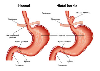 L'ernia iatale è una dislocazione intratoracica di una porzione dello stomaco attraverso lo iato esofageo del diaframma.L'ernia iatale si divide in due tipi: di ernia iatale da scivolamento e ernia paraesofagea.Nell'ernia iatale da scivolamento lo iato esofageo subisce in genere un' allargamento. L'ernia paraesofagea sembra dovuta alla presenza di un difetto o di un'area localizzata di minore resistenza a livello della membrana frenoesofagea. La prognosi in dell'ernia iatale da scivolamento asintomatica non accompagnata da reflusso gastroesofageo è eccellente. L'ernia iatale da scivolamento, in assenza di una patologia da reflusso gastroesofageo e da altre complicanze, non richiede alcun trattamento ee il soggetto che ne è portatore non va etichettato come malato.L'eziologia nella maggior parte dei casi di ernia iatale è sconosciuta.