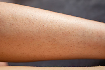 unshaven female leg. Leg of a girl with regrown hairs