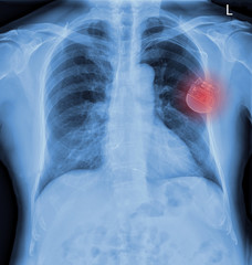 Chest X-ray with pacemaker placement