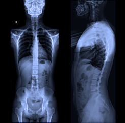 X-ray of whole spine AP & Lateral position in dark background.