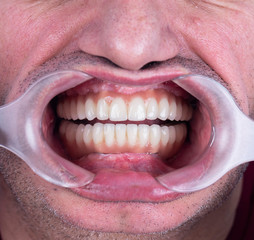 Obraz premium full mought re construction by dental implants and ceramic crowns