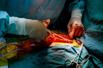Staring to close the abdomen with a suture in the open heart operation