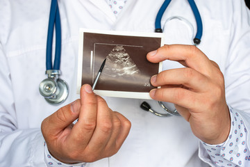 Polycystic kidney disease on ultrasound image concept photo. Doctor indicating by pointer on printed picture of ultrasound pathology of many cysts in kidneys. For diagnosis, radiology, nephrology