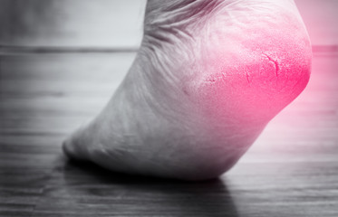 Closed-up of cracked heels with red spot, also known as fissures, a common foot problem. black and white tone