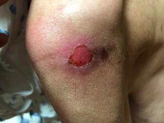 wound