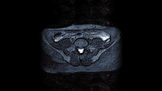 Volumetric contrast MRI of the abdominal cavity, gastrointestinal tract, bladder