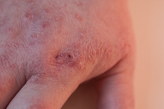 Psoriasis auf der Handoberfl&auml;che