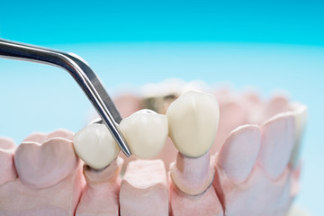 Fototapeta na wymiar Closeup / Prosthodontics or Prosthetic / Teeth crown and bridge implant dentistry equipment and model express fix restoration.