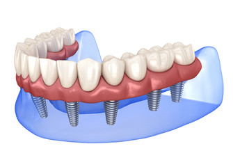 Maxillary and Mandibular prosthesis with gum All on 8 system supported by implants. Medically accurate 3D illustration of human teeth and dentures