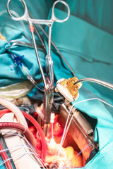 Implantation of artificial heart valve