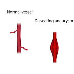 Normal vessel and dissecting aneurysm. Medical anatomy illustration.