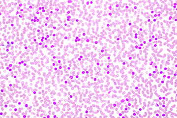 Blood picture of chronic lymphocytic leukemia or CLL, analyze by microscope, original magnification 400x