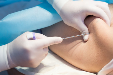 An oncologist, using a long needle, pierces a childs ilium to diagnose bone marrow for leukemia,...