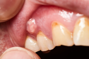 inflammation of the gums abscess closeup - obrazy, fototapety, plakaty