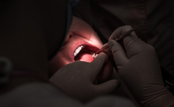 tdentistry. dental treatment, close-up. teeth and caries.