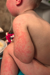 Fototapeta premium Allergies, pimples on the baby's skin. Food allergy.