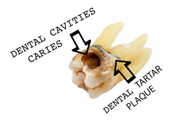 extracted caries tooth with the notation of pathology isolated on white background close-up macro, upper molar