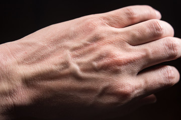 Fototapeta premium dry skin close-up on a black background, allergy, skin peeling, moisturizing