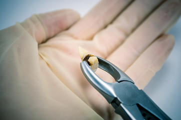 extractive caries tooth in surgical forceps on white background close-up macro, upper wisdom molar,...
