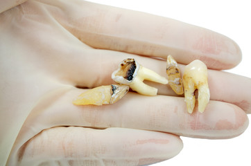 extractive caries tooth in the hand of a dentist surgeon on a white background close-up macro, upper and lower molar wisdom, incisor, canine, destroyed tooth filling, isolated