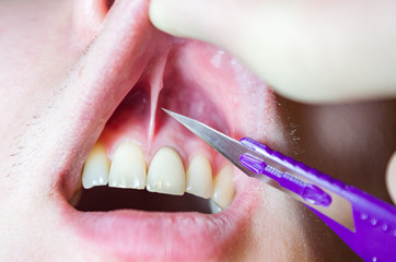 dentist surgeon with a scalpel, the operation in the oral cavity, shortened bridle, a dental...