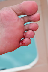 Incised wound on the leg of people