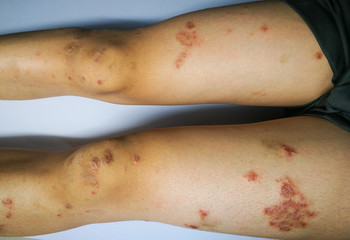 Young boy has Chronic rash on skin. Grass allergic skin disease. Atopic dermatitis. Age spot skin
