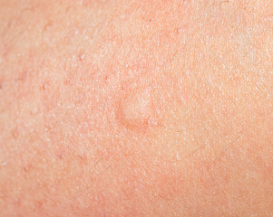 trace from a mosquito bite on the skin