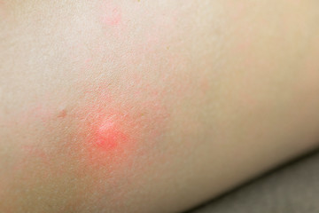 Fototapeta premium Allergies from mosquito bites on the skin