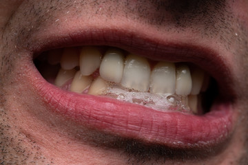 Image of man with open mouth, showing teeth
