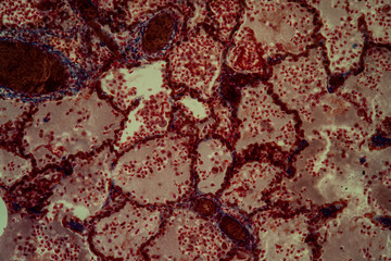 Lungentuberkulose Gewebe unter dem Mikroskop 200x