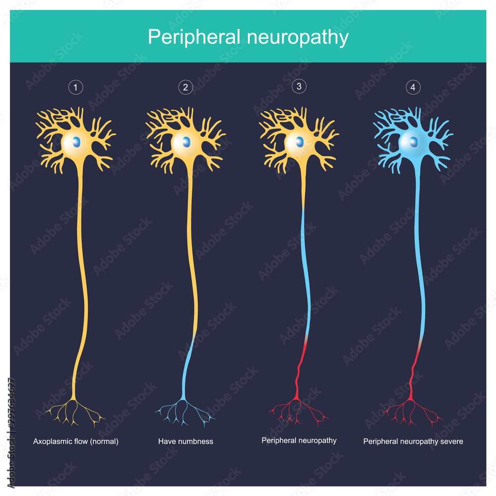 Wall mural peripheral neuropathy. explain illustration for the peripheral neuropathy have numbness until severe