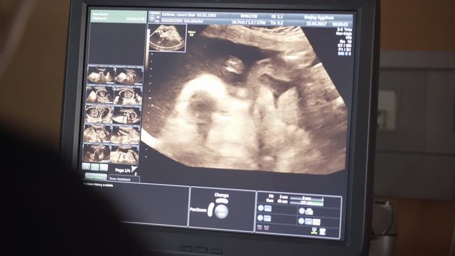 Focused Shot of an Ultrasound Video of a Baby Using a Sonogram Machine