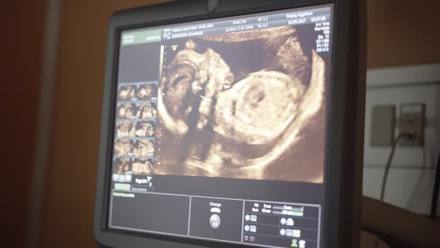 Ultrasound Monitor Showing a Fetus in Different Angles