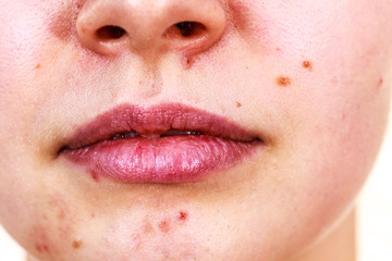 Female face with acne skin problem