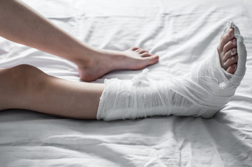 Broken leg in white plaster lies on the bed
