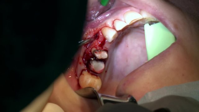 Dentist do treating teeth a patient in modern office clinic operating room uses modern dental equipment and anesthesia. Close-up dental care oral and maxillofacial implant surgery.