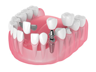 3d render of jaw with dental implants and bridges over white