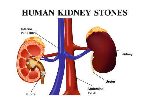 Human Kidney Stones