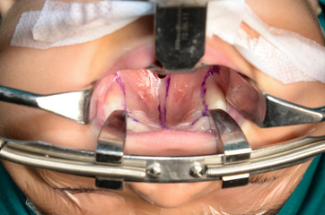 Young patient with cleft lip and cleft palate are treated by surgeons in operating room at the...