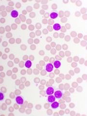 Blood picture of chronic lymphocytic leukemia or CLL, analyze by microscope, original magnification 1000x