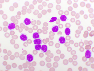 Blood picture of chronic lymphocytic leukemia or CLL, analyze by microscope, original magnification...